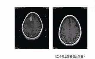 脑转移瘤的检查诊断和治疗方案