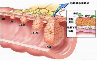 直肠癌的辅助检查方法知多少