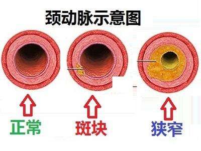 生活中应如何预防颈动脉狭窄